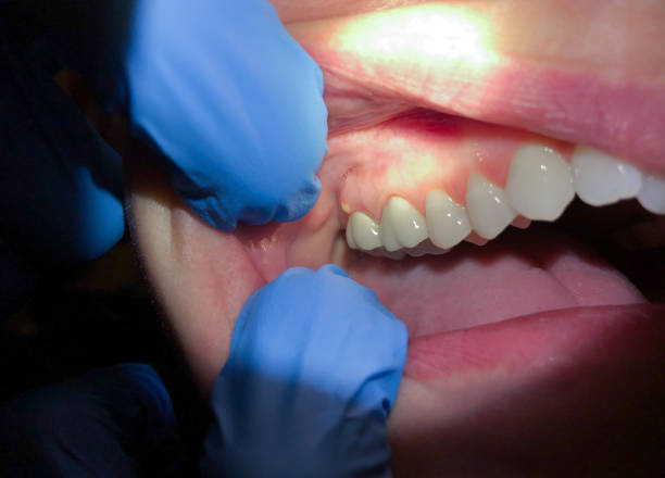 Best Emergency Dentist for Lost Fillings or Crowns in Portland, TN